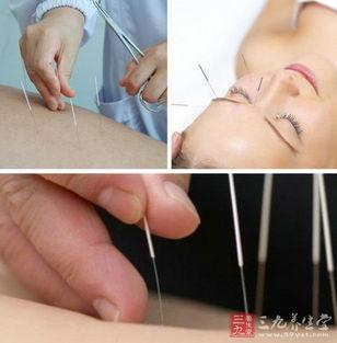 成人鼻炎灸针灸视频,视频详解,轻松缓解鼻炎不适